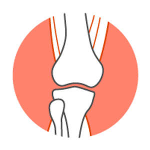 AGEs impact on the bones