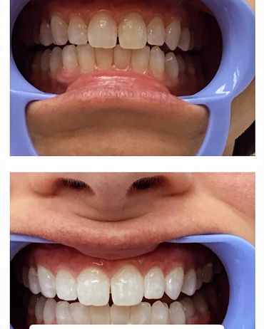 Teeth whitening before and after. Instant Results. Professional teeth whitening. Port Charlotte FL