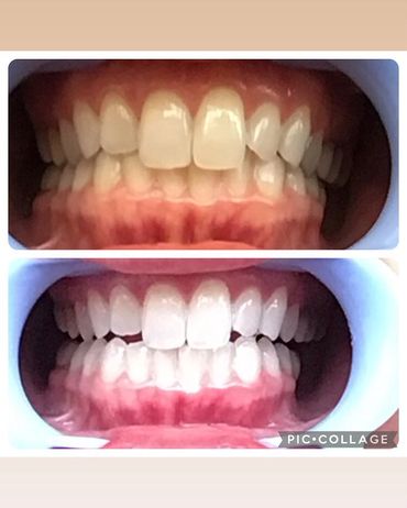 Teeth whitening before and after. Instant Results. Professional teeth whitening. Smile near me
