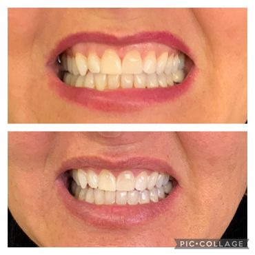Teeth whitening before and after. Instant Results. Professional teeth whitening near me