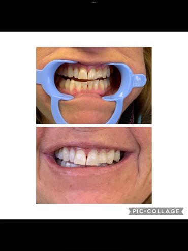 Teeth whitening results