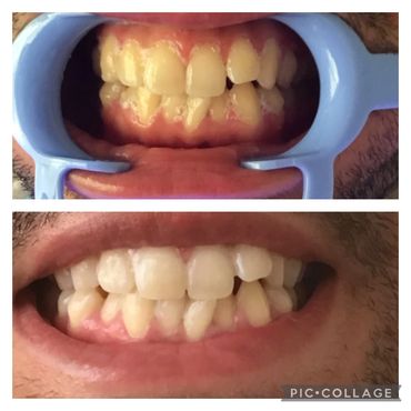 Teeth whitening before and after. Instant Results. Professional teeth whitening near me.