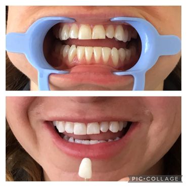 Teeth whitening before and after. Instant Results. Professional teeth whitening. Charlotte Harbor FL