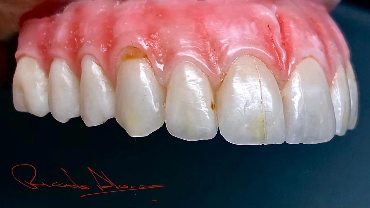 Diagnostic Wax-Up