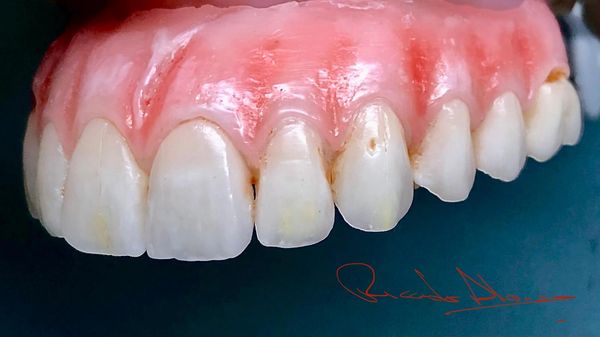 Diagnostic Wax-Up