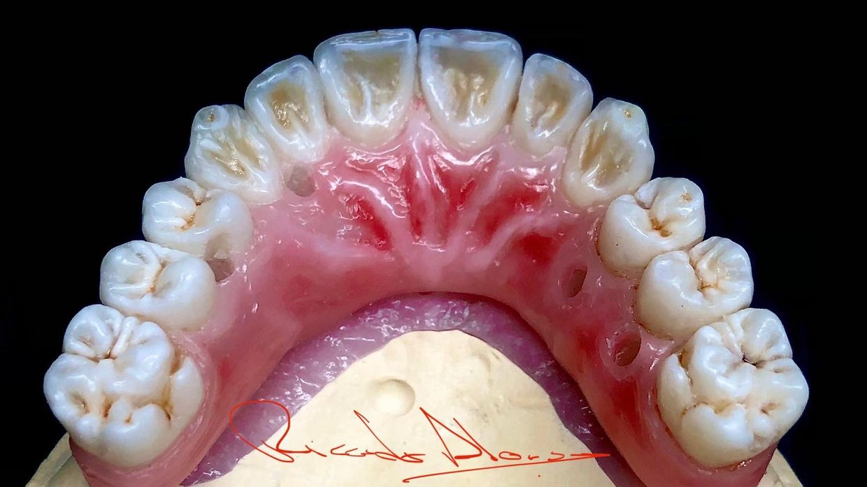 Diagnostic Wax-Up
