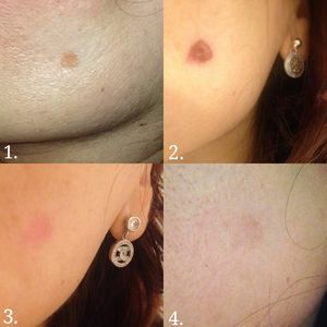 proceso de eliminacion de manchas
costra
eliminacion completa
manchas
sin cicatrices ni marcas