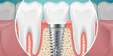 Explicacion grafica del funcionamiento de un implante dental