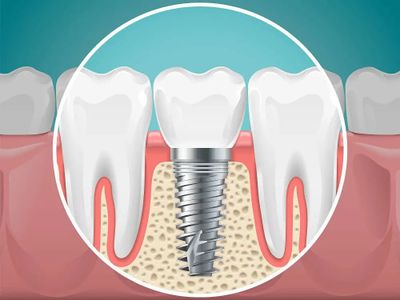 Explicacion grafica de como funciona un implante dental
