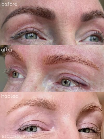 Before, After, & Healed Results after 1 session of Laser PMU Removal