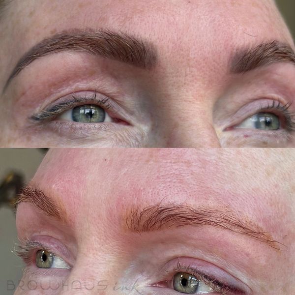 Before & after just 1 session of laser PMU removal.