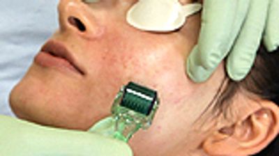 Derma Roller facial treatment