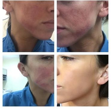 Dermaquest chemical peel