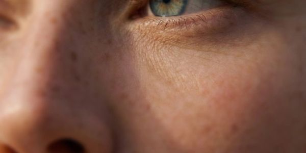 Close-up of a person's eye and nose showing skin texture and freckles.