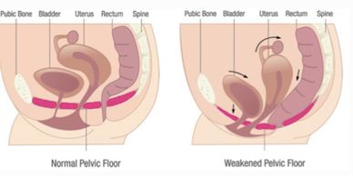 Comparison of normal vs weakened pelvic floor anatomy.