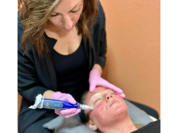skinpen medical facial treatment by registered nurse at peak aesthetics midvale idaho