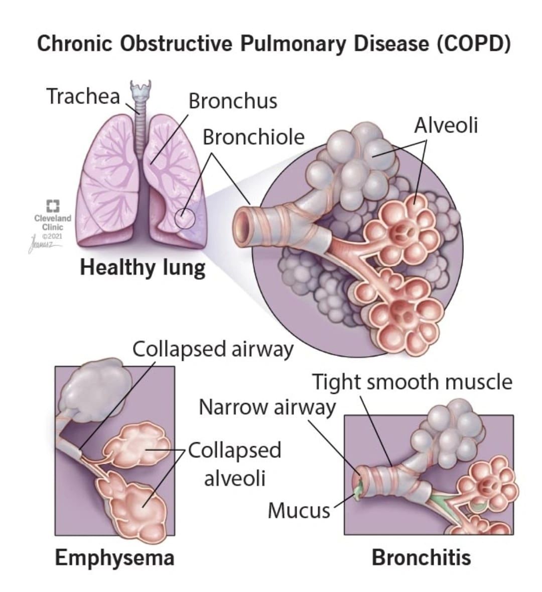 COPD COPD