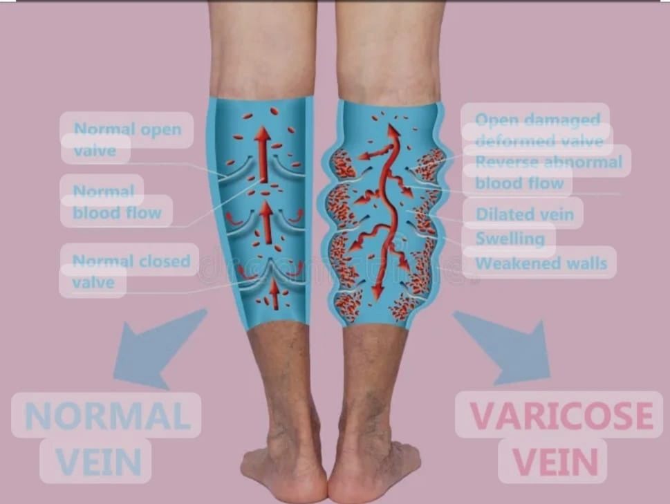 varicose veins varicose veins