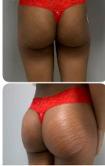 before-and-after images showing the buttocks area with visible lifting and smoothing results after B