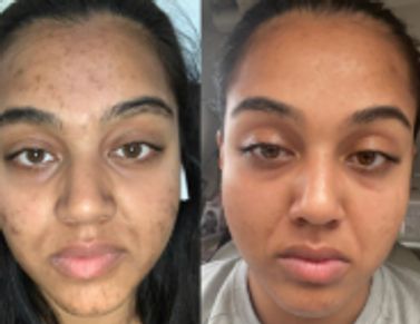 Client showing improved skin clarity and reduced blemishes after receiving a Lactic Acid Peel at the