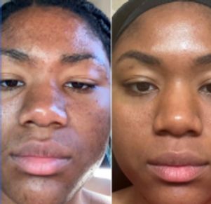 Client showing reduced hyperpigmentation and clearer skin after the Mandelic Acid Peel at Blossom Be