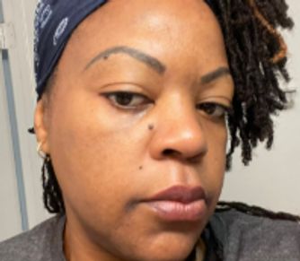 Selfie of a woman showing her face immediately before or after a Microneedling Facial treatment