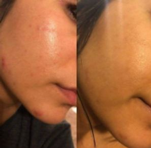 Before & after image showing smoother skin texture and glow after the Platinum Pumpkin Enzymes Peel.