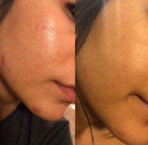 Before & after image showing smoother skin texture and glow after the Platinum Pumpkin Enzymes Peel.