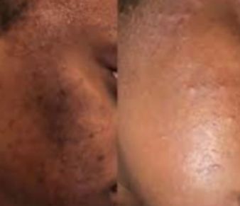 Comparison of a person's skin, showing improvement in dark spots and texture after a TCA Chemical Pe