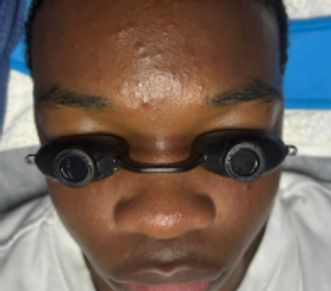 Teen client wearing protective black goggles while receiving the Teen Spirit Facial treatment