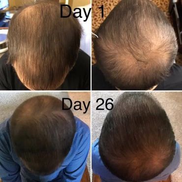 Thicker hair follicles after activating mitochondria with topical scalp application of Nrf2