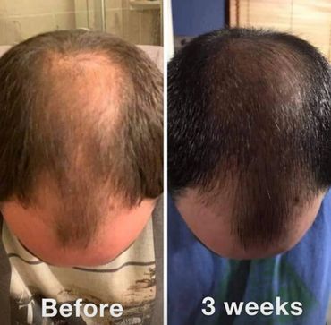 Thicker hair follicles after activating mitochondria with topical scalp application of Nrf2