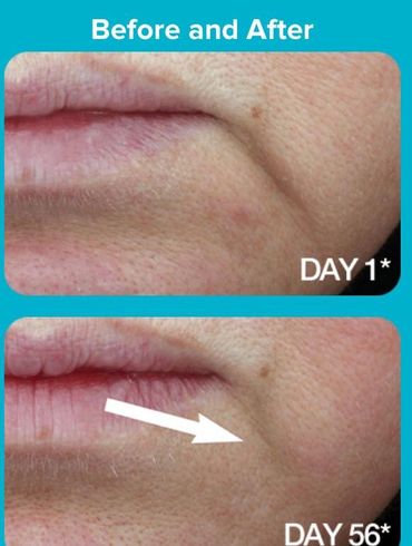 marionette line fading with Nrf2 activation