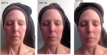 Skin looking younger after Nrf2 activation...fewer wrinkles, less saggy skin, more skin tightness