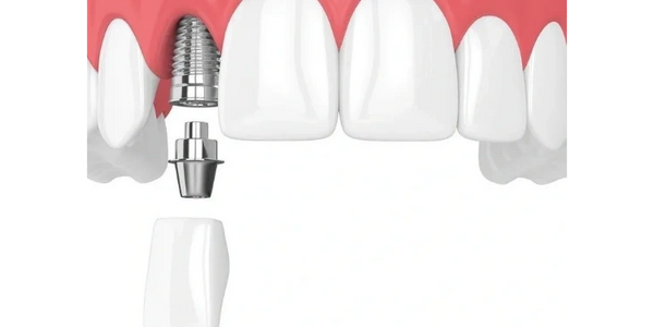 DENTAL IMPLANTS