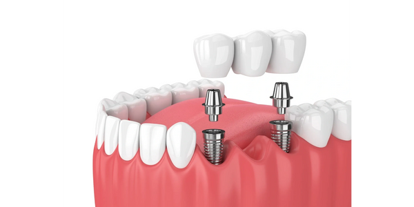 DENTAL IMPLANTS