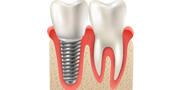 DENTAL IMPLANTS
