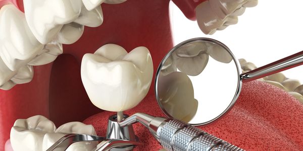 TEETH IMPLANT