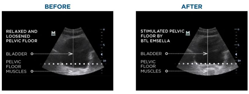 Ultrasound Emsella