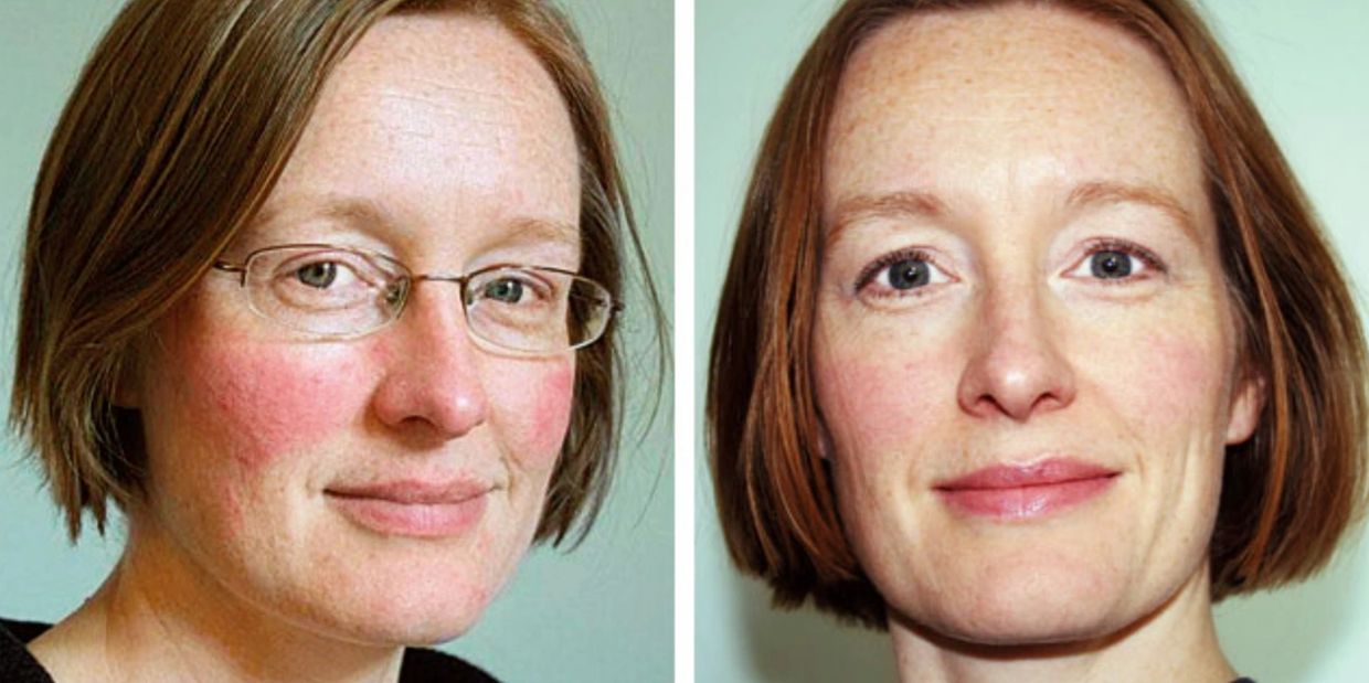 Woman with Rosaces of the cheeks before and after laser therapy.The after has less facial redness