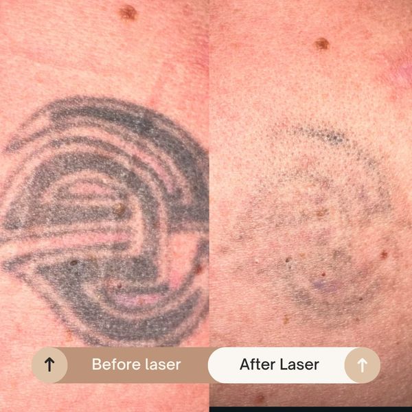 Laser tattoo removal service near me, Knottingley laser clinic, West Yorkshire laser tattoo removal