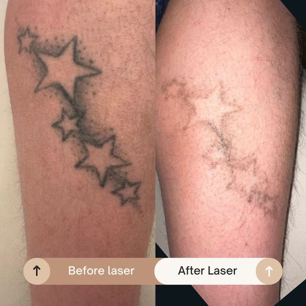 Tattoo fading Knottingley tattoo cover ups West Yorkshire laser removal near me tattoo removal