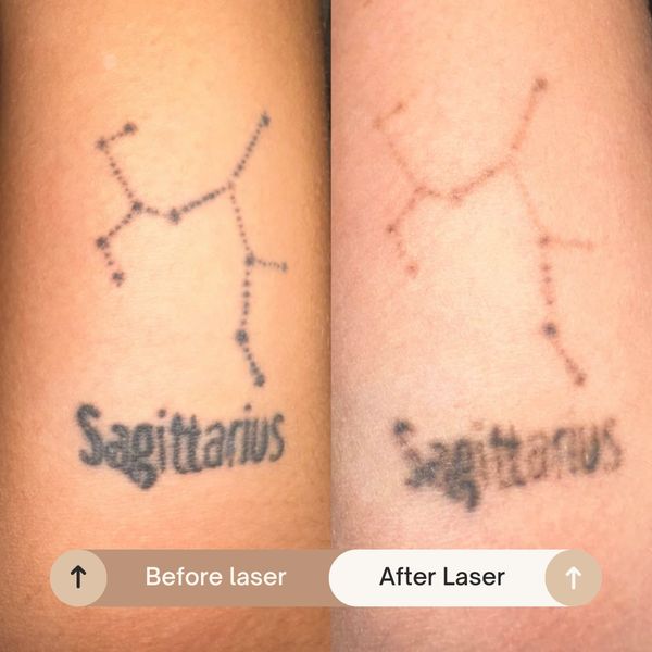 Tattoo removal clinic in Yorkshire safe tattoo removal NDyag laser tattoo regrets