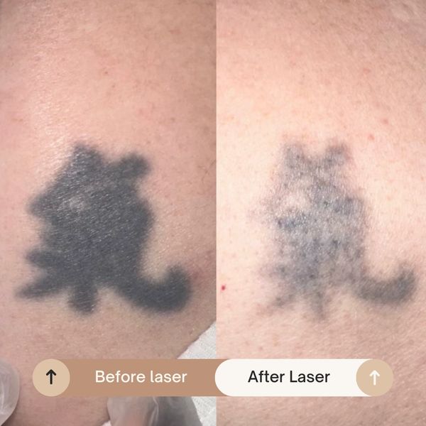 Tattoo regret solution Tattoo removal for adults Tattoo removal in your 30s