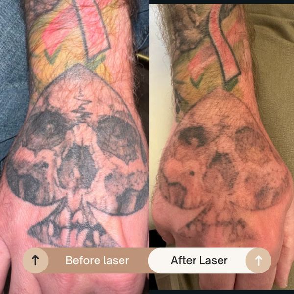 Safe tattoo removal Pico laser tattoo removal Remove unwanted tattoos Fading tattoos for cover-ups