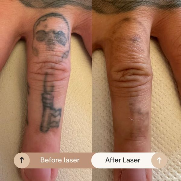 Tattoo removal in West Yorkshire, laser Pontefract, laser Normanton, Laser Wakefield, tattoo removal
