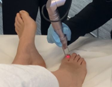 Fungal nail treatment West Yorkshire laser fungal nail treatment near me fungal nail infection