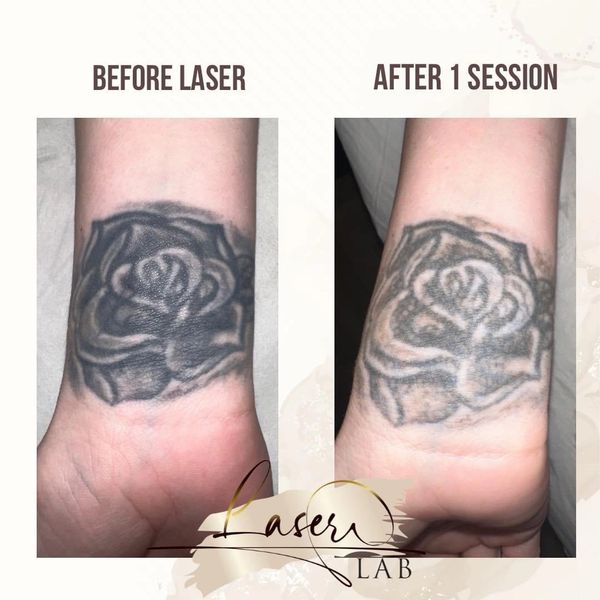 Tattoo removal results, tattoo removal treatment near me, laser clinic in west yorkshire, laser