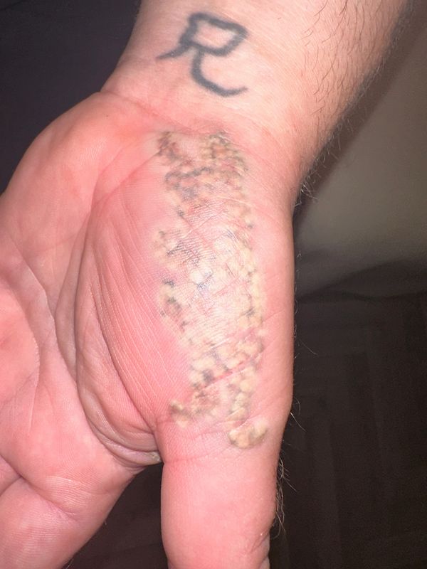 laser treatment, tattoo removal, removals knottingley, tattoo treatment, laser tattoo removal, laser