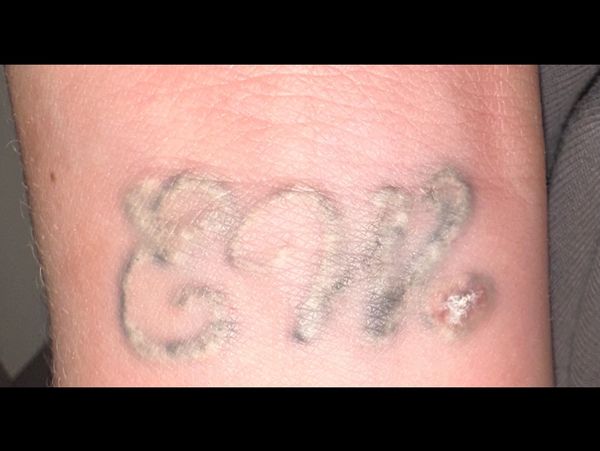 Laser removal treatment immediately after, tattoo removal after care, tattoo removal, yorkshire